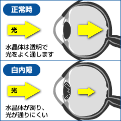 白内障とは？