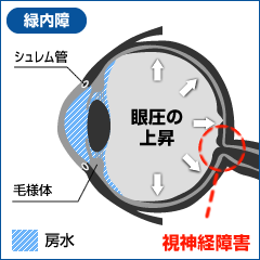 白内障とは？