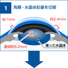 角膜、水晶体前嚢を切開します