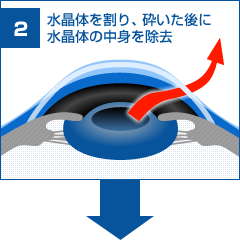 水晶体を砕き、濁った水晶体を除去します