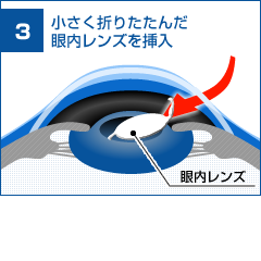 眼内レンズを挿入します