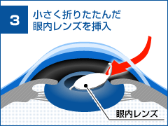 水晶体を砕き、濁った水晶体を除去します